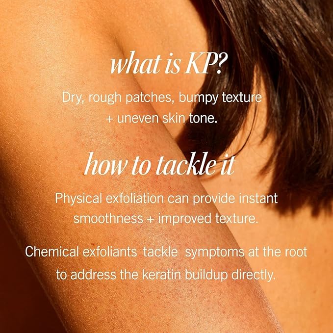 First Aid Beauty - KP Bump Eraser Body Scrub with 10% AHA, Keratosis Pilaris Skin Exfoliater with Glycolic and Lactic acids, Helps Reduce Chicken Skin Bumps, Safe for Sensitive Skin, 10 oz